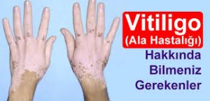 vitiligo nasıl bir deri hastalığıdır